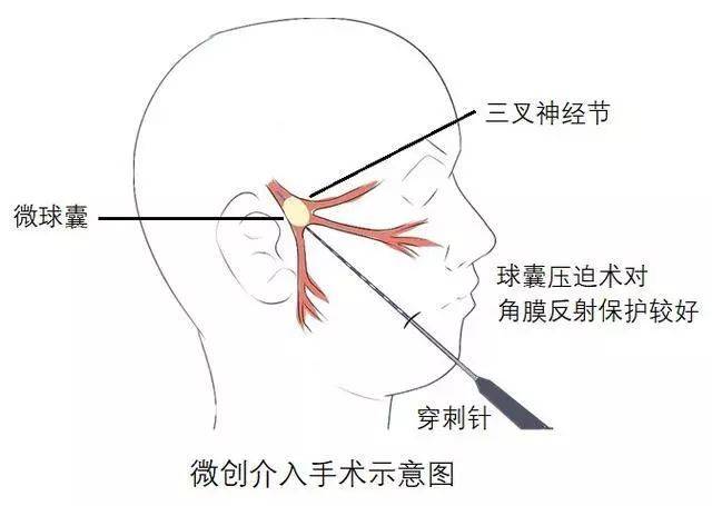 专家解密"天下第一痛"-------三叉神经痛!