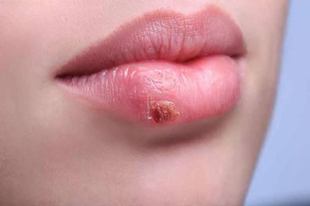 单纯疱疹临床上以 口唇,口周,鼻孔附近出现簇集性水疱为特征.