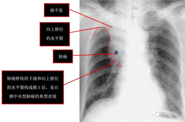 患者年龄大,慢性病程,痰中带血,这个临床表现就倾向先考虑肺癌,胸片