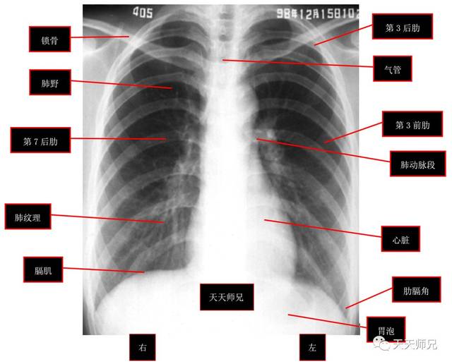 天天师兄说明 正常胸片及其需要牢记的正常结构