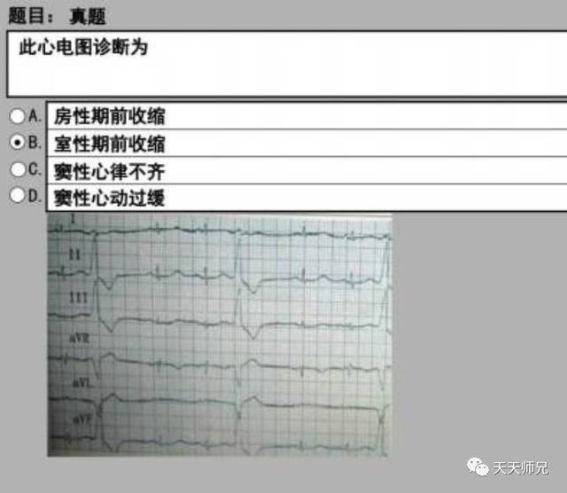 天天师兄说明: 靴型心:心脏形状像靴子一样,特点就是心腰明显凹陷,左