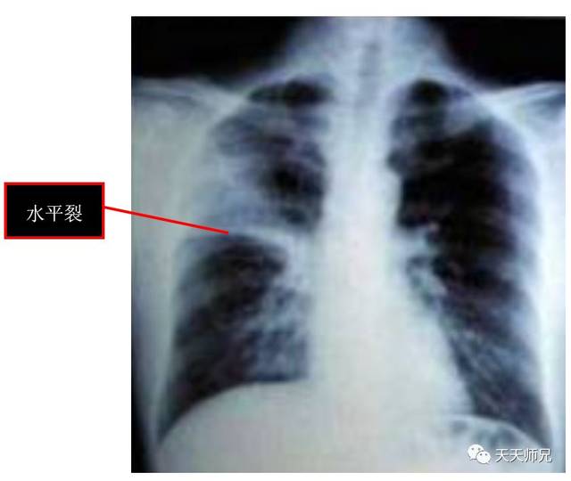 肺不张会导致叶间裂向不张的肺组织移位,本题中右侧的水平裂没有移位