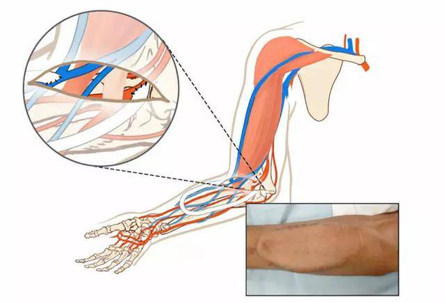 图2,前臂环装动静脉人工移植血管(图片来源于透析血管通路图谱)