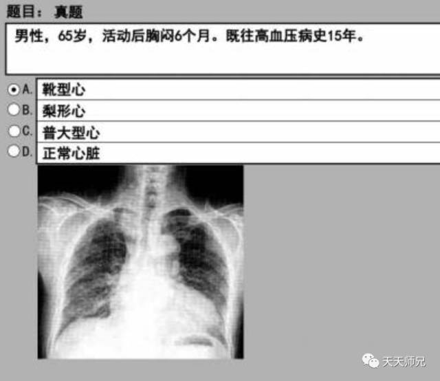 另外靴形心经常和体循环的问题搭上边,比如主动脉瓣关闭不全,主动脉瓣