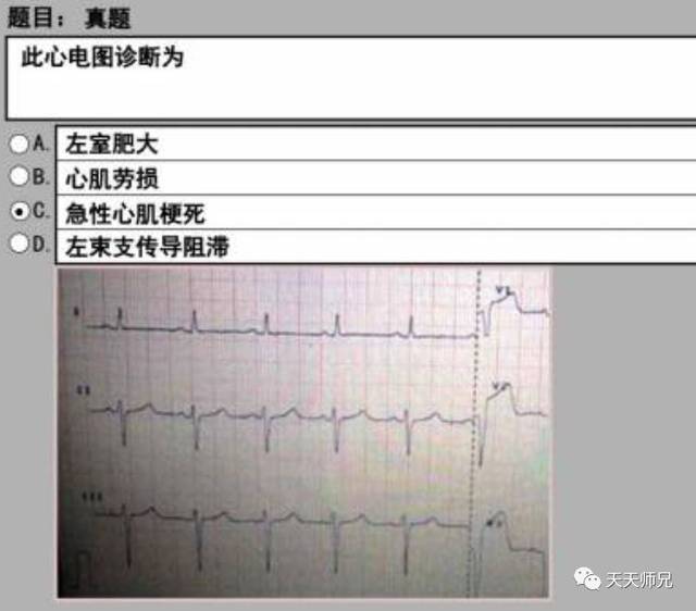 另外靴形心经常和体循环的问题搭上边,比如主动脉瓣关闭不全,主动脉瓣