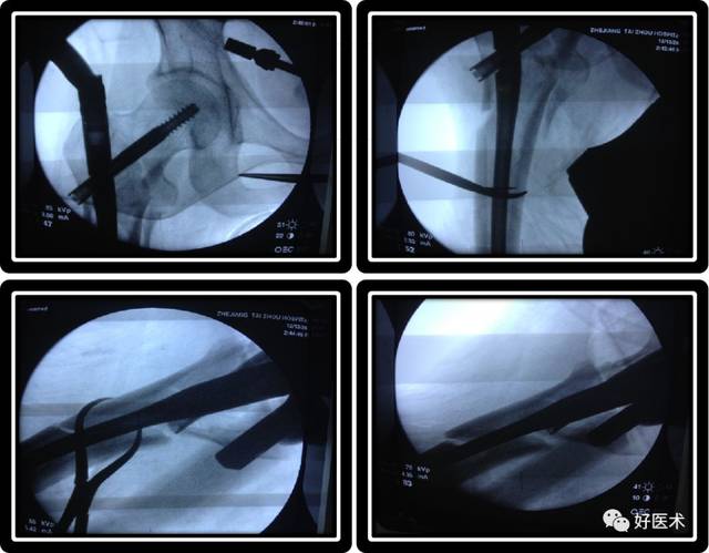 撬拨复位 近段股骨干骨折从大转子尖进针的髓内钉比梨状窝进针者损伤