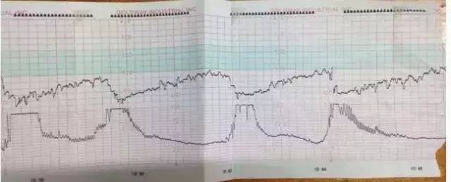 心动过速:>160次/分 胎心率变化呈平滑的,正弦波样改变,频率3～5次/分
