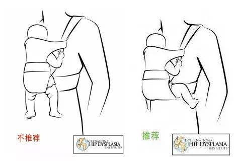 宝宝臀纹不对称,1岁后发现就晚了! | 髋关节