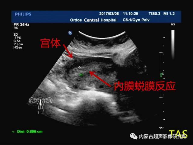 宫颈妊娠超声诊断