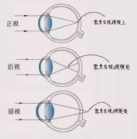 屈光参差如何正确配镜?