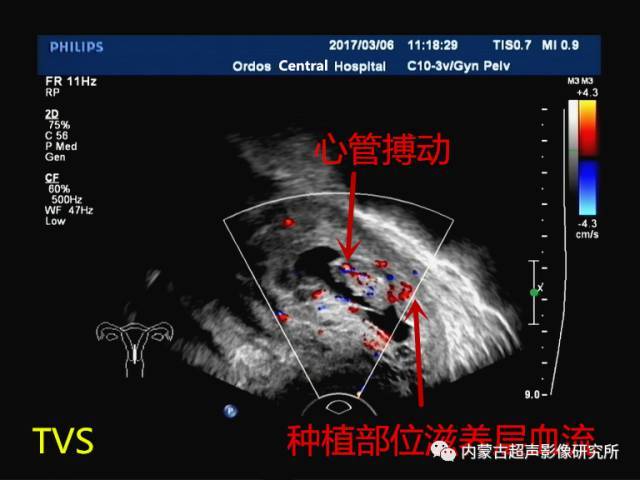 宫颈妊娠超声诊断