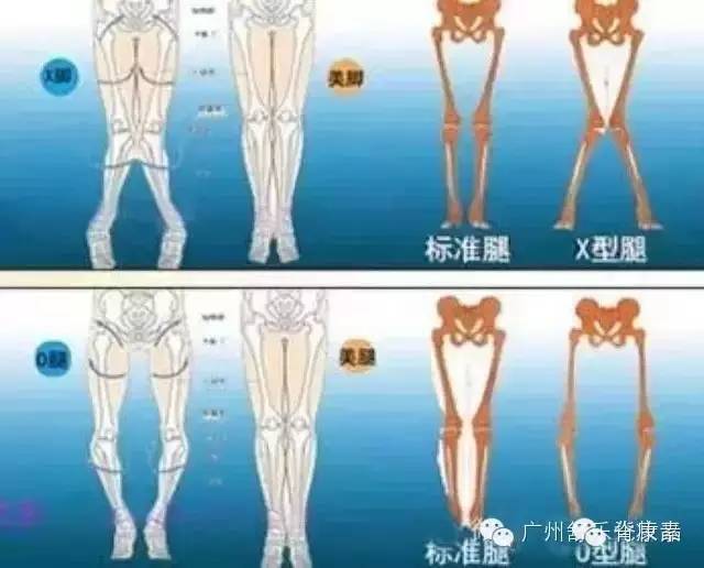 骨盆的左右高度不一和髋关节内外旋处理思路_手机搜狐网