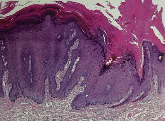 寻常疣病理图 临床类型有4种:1.寻常疣,2.跖疣,3.扁平疣,4.