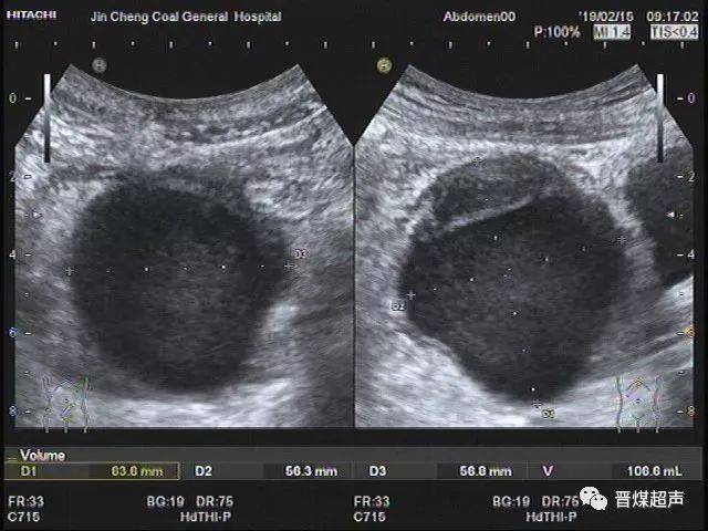 盆腔卵巢囊肿,大小6.4cm×5.6cm×5.7cm.