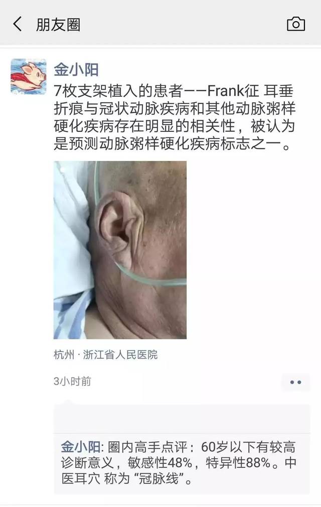 浙江省人民医院心内科金钦阳主治医师的朋友圈 "耳折征"为何与冠心病