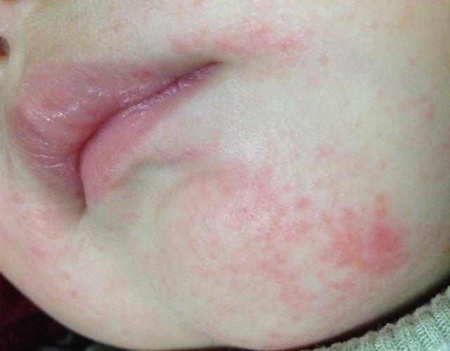 3 口水疹 口水疹又称"口周湿疹,常发生在2个月~1岁左右宝宝的身上.