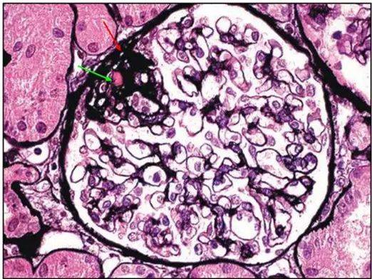 小动脉透明样变等表现,原则上诊断该图 1 肾小球的绿色:肾小球脏层上