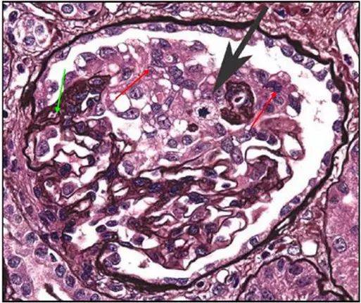 红色箭头:毛细血管袢固缩,塌陷,毛细血管腔闭塞;绿色箭头:足细胞增生