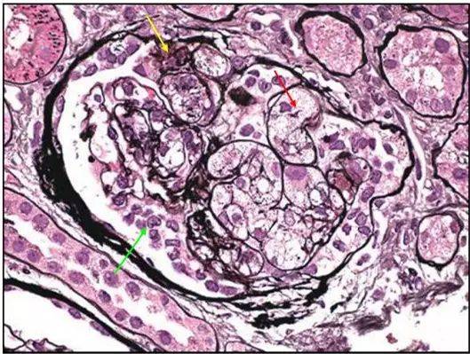 肾内病理图解 | 局灶节段性肾小球硬化_手机搜狐网