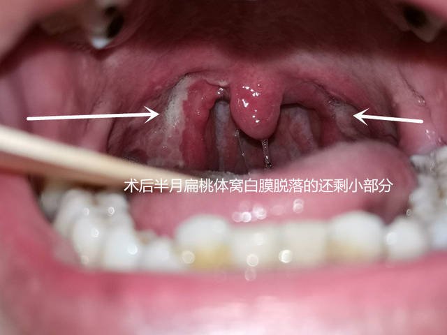 扁桃体术后出血怎么办? (原创)