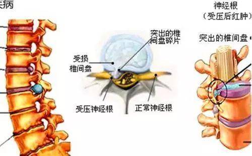 如何缓解腰椎间盘突出疼痛?