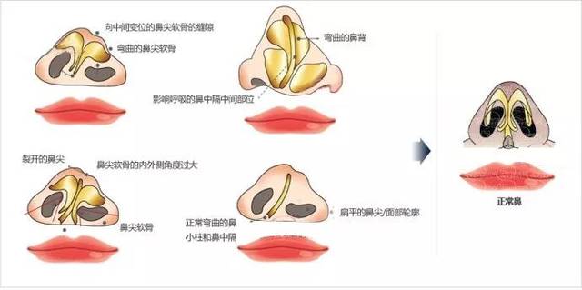 鼻前庭畸形的修复