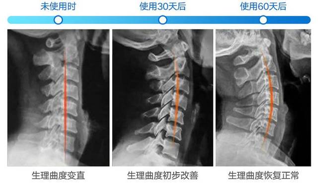 睡它!3天不酸胀,60天颈椎正常血压下降