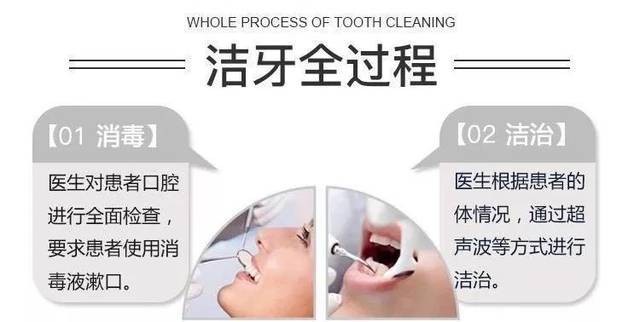 洗牙绝对不是单纯的冲洗就搞定 口腔检查拍片 清洁 抛光 以上步骤一