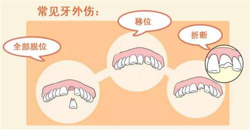 东阳17岁小伙打球折断门牙,医生这样做.牙齿竟