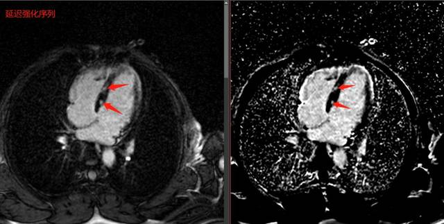 特征之一为脂肪组织浸润心肌,因此在常规t1及t2序列上表现为高信号,磁
