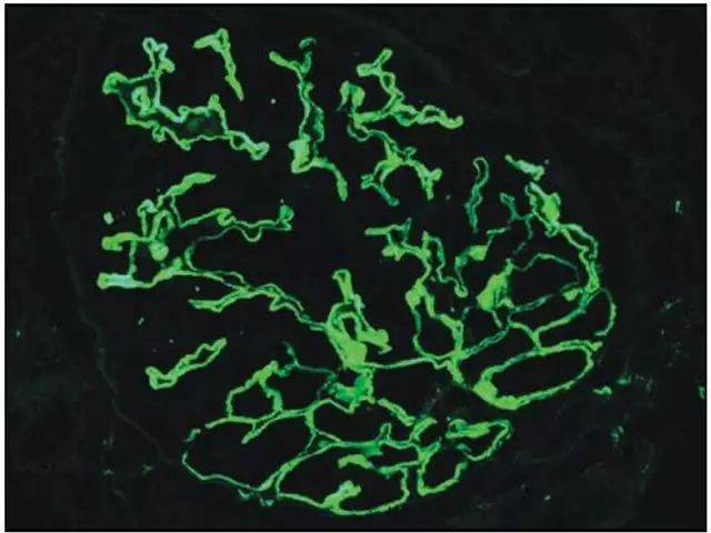 11为典型的膜性肾病免疫荧光表现:igg 沿肾小球毛细血管壁呈粗颗粒