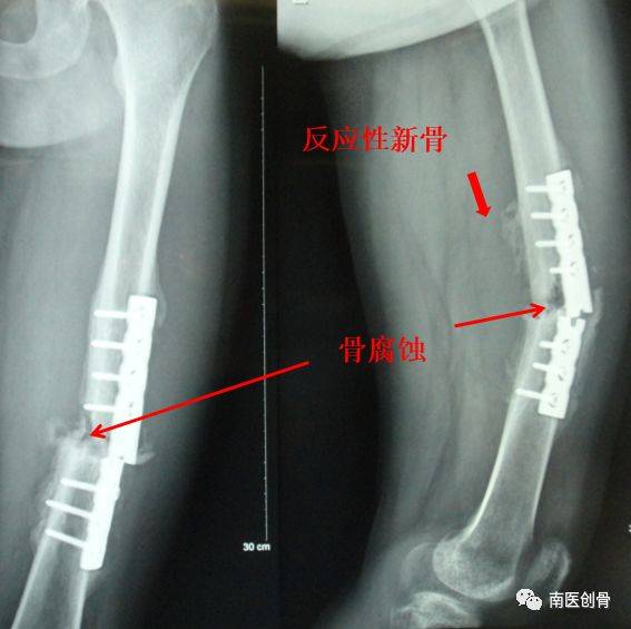 影像学检查 1,x线检查 可见骨腐蚀现象 反应性新骨但不是骨痂 远离