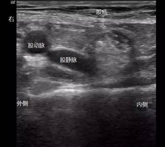 示右侧腹股沟区横切面声像图,与股静脉内侧可见中强回声疝出,为