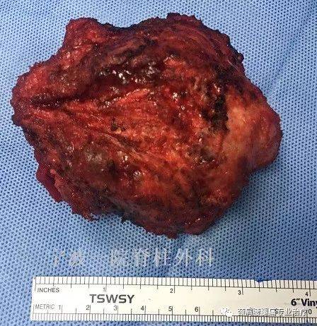手术切下的骶骨肿瘤的后面观