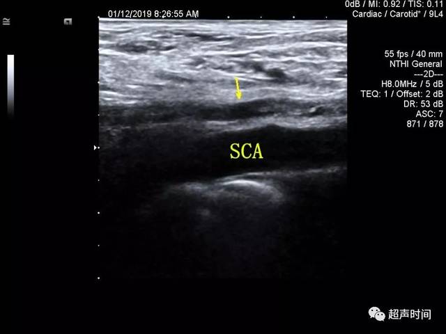 超声典型病例:臂丛神经鞘瘤