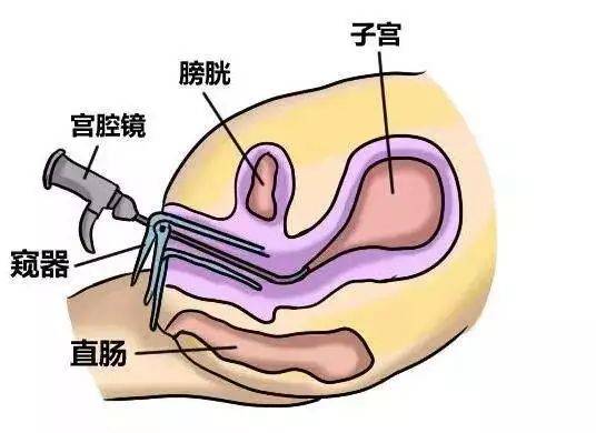 宫腔粘连内膜过薄看宫腔镜如何治疗不孕症