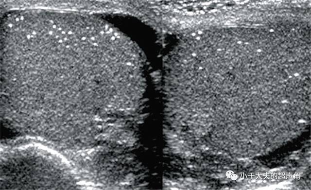 这即是我们常说到的睾丸微石症(testicular microlithiasis),较常见