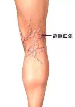 有的人的腿上会出现一些"蚯蚓纹",就是有明显的青筋和红血丝,腿部还会