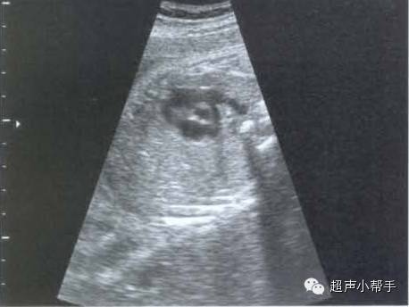 手把手教你做胎儿超声心动图_手机搜狐网