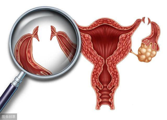卵巢癌为何这样"静悄悄",女性应注意这5大症状!