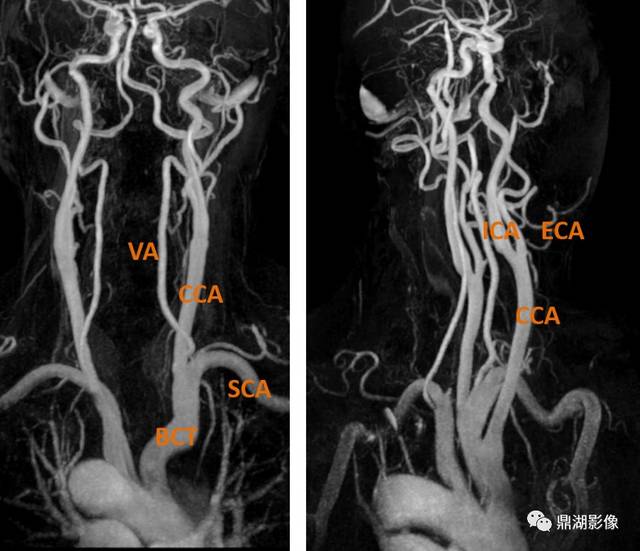 无名动脉(头臂干, brachiocephalic trun,bct)-右侧颈总动脉rcca