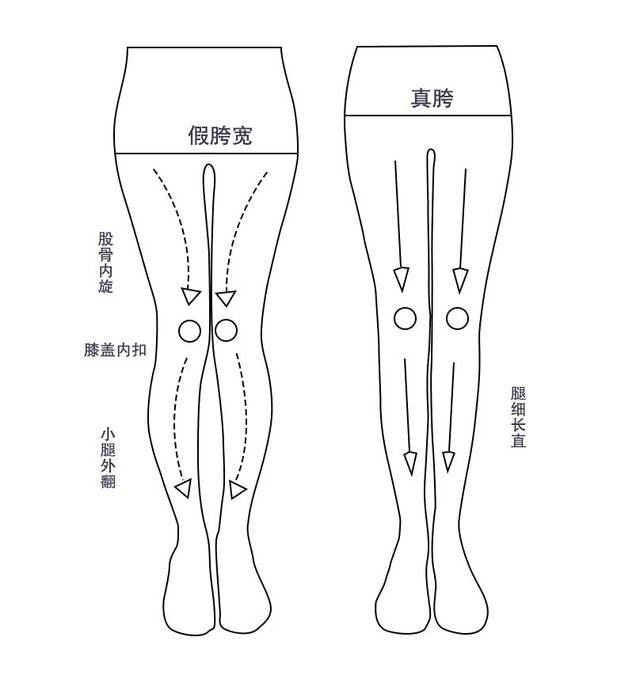 大转子的过度内旋,还会导致膝盖内扣,x型腿,双腿并不拢,小腿肚外翻