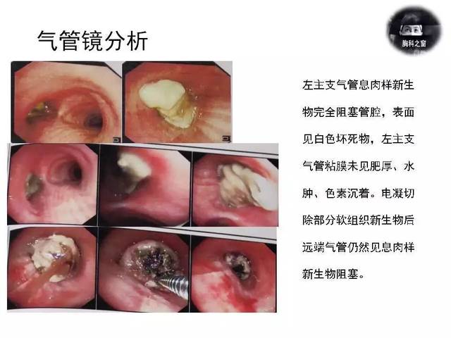 230期:多次活检最终确诊--癌肉瘤一例