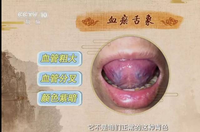 ① 舌头:舌下出现血管粗大,血管分叉,颜色暗紫的状态时,可能是血瘀