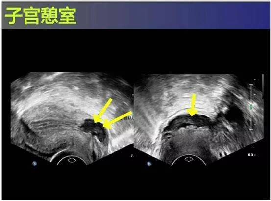 3)b超检查 子宫前壁下段存在宫腔内凸向浆膜层的锲形缺损,对缺损区