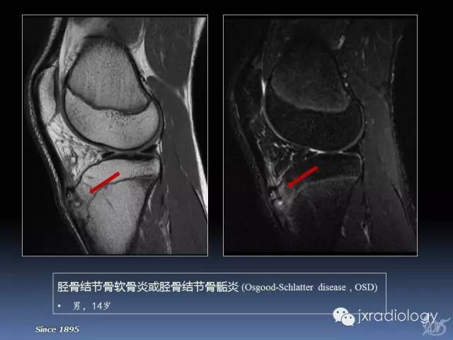 膝关节肌腱病变mri诊断