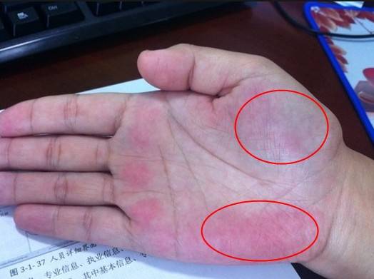 "2红": 手掌红:若一个人出现手掌通红,或有红色斑点,经过按压后变