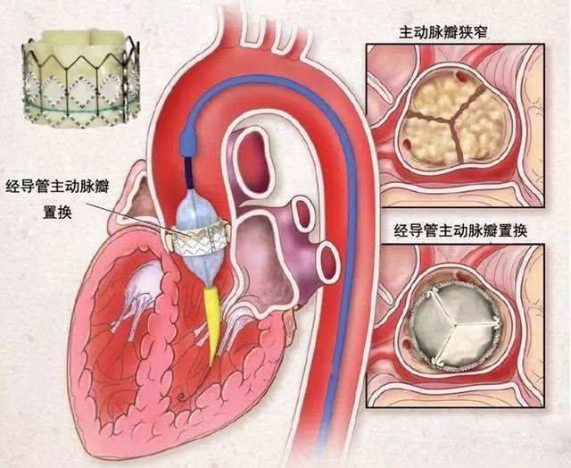 【科普】谈谈结构性心脏病