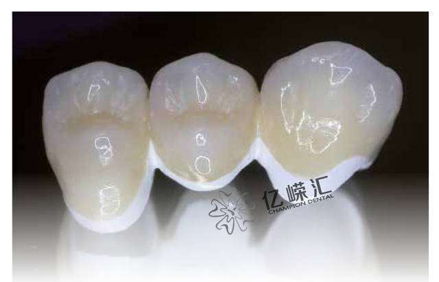 hpp应用修复主要分为3个核心 固定修复 单冠 桥(最多两个桥体) 桥粘结