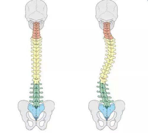 当我们出现上述体态问题后,我们的外形先不论,我们的脊柱会发生变形